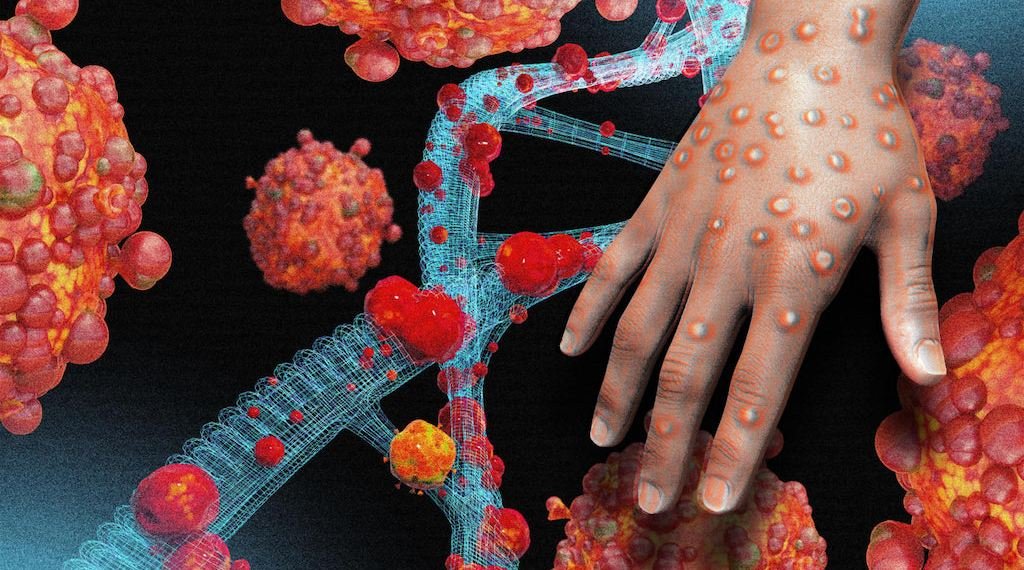 Leia mais sobre o artigo Ministério da Saúde confirma primeiro caso de mpox pela cepa 1b